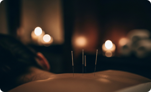 Acupuncture